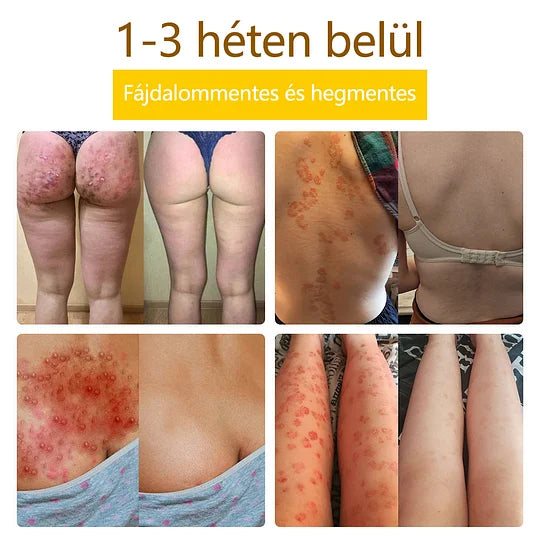 flysmus™🐝: eczema, psoríase, acne, rosácea, infecções fúngicas, verrugas